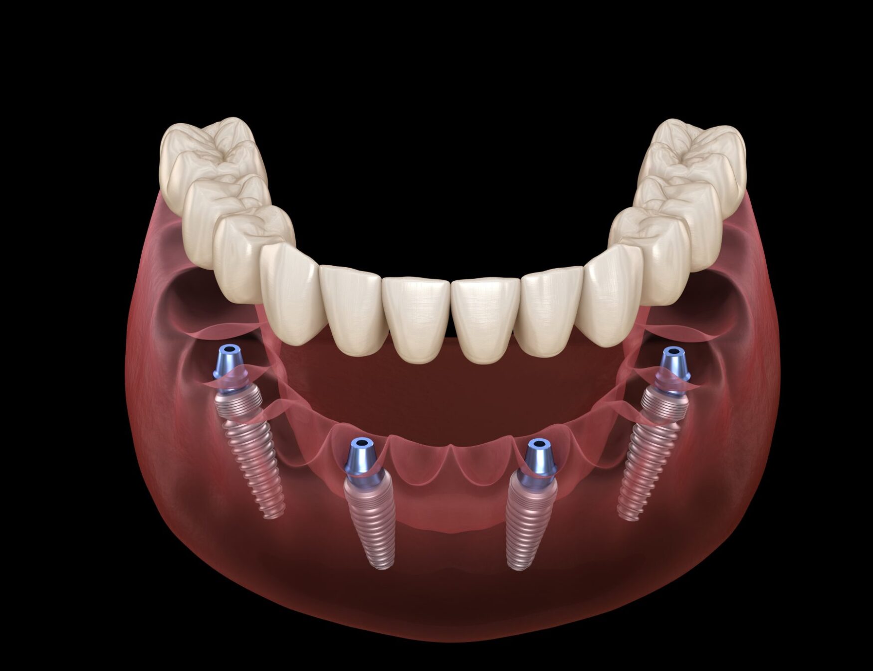 All-on-4 Fixed Implant Prosthesis